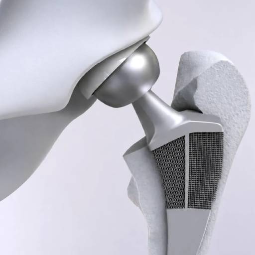 Novel hip implant